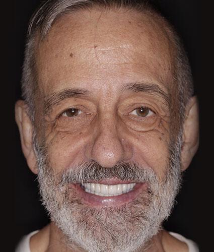 Full Mouth Reconstruction
