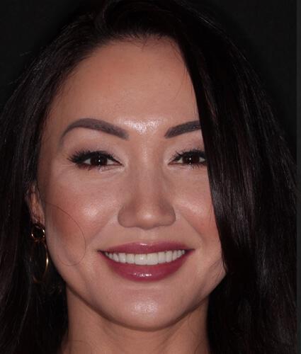 Smile Makeover