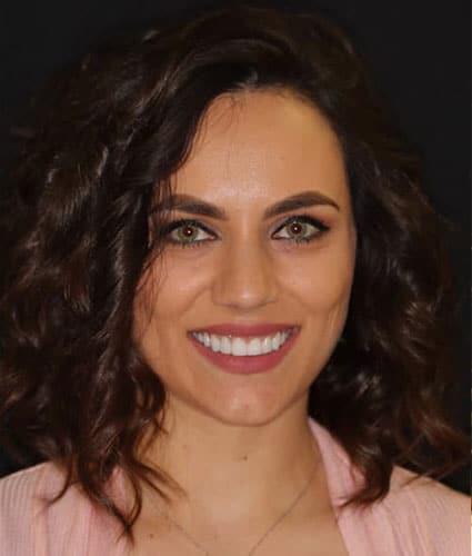 Porcelain Veneers