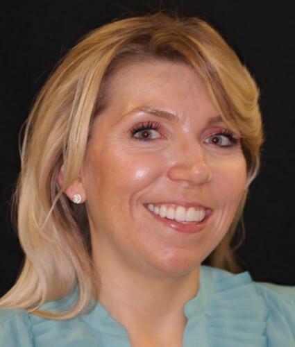 Porcelain Veneers