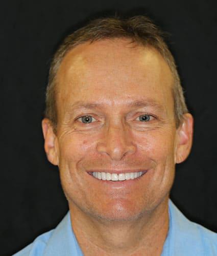 Facial Rejuvenation