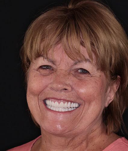 Smile Makeover