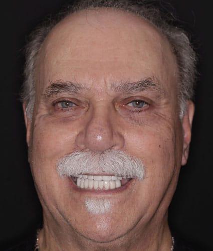 Porcelain Restorations