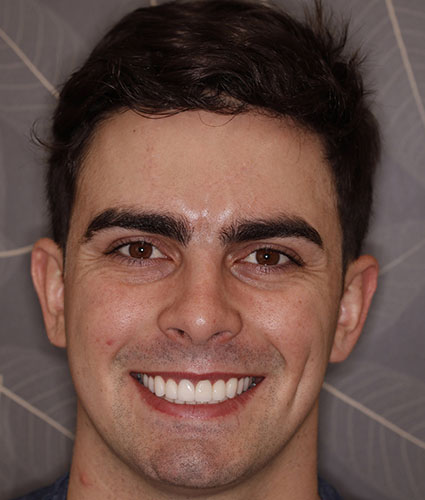 Porcelain Veneers