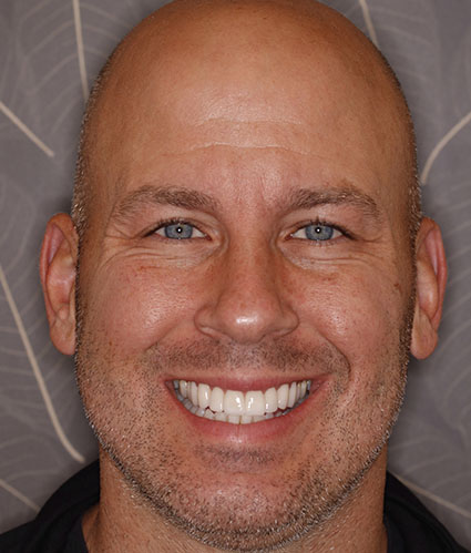 Porcelain Veneers