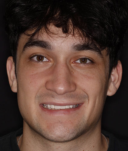 Porcelain Veneers