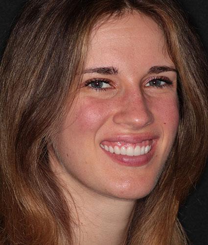 Laser Gum Lift and Porcelain Veneers