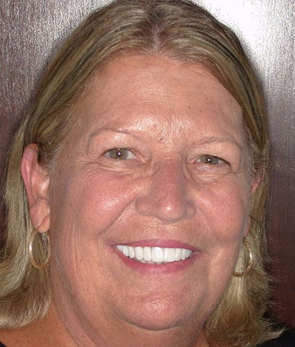 Smile Makeover