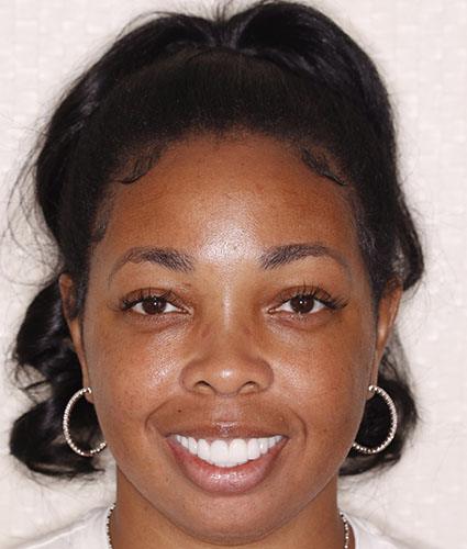 Smile Makeover