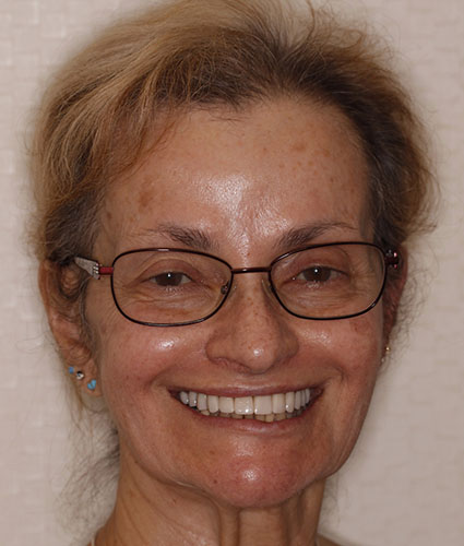 Full Mouth Reconstruction