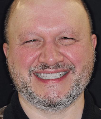 Full Mouth Reconstruction