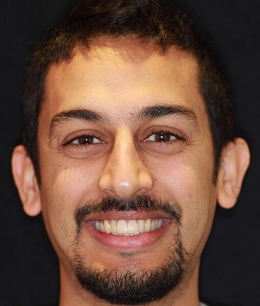 Implant Crowns