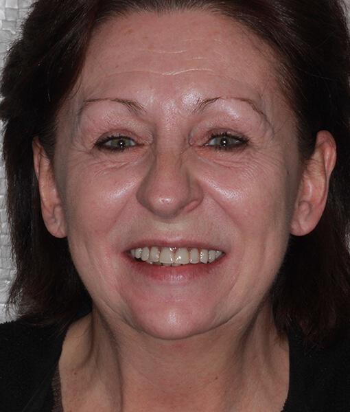Implant Dentures