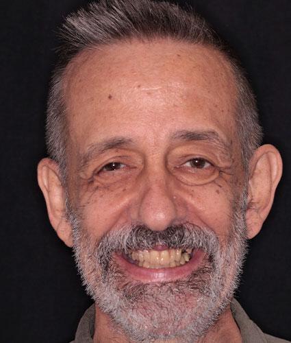 Full Mouth Reconstruction
