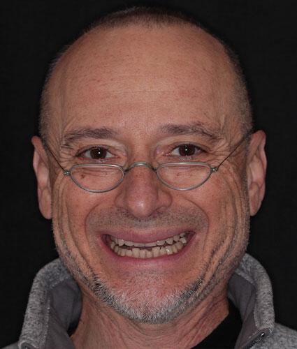 Porcelain Veneers