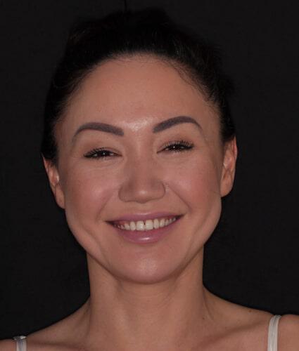 Smile Makeover