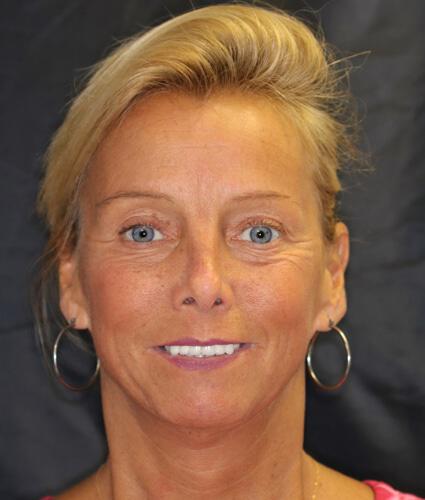 Smile Makeover