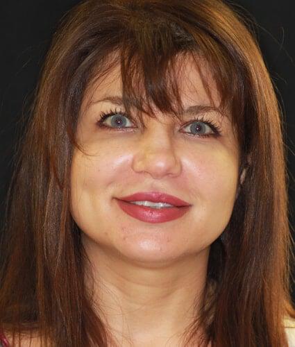Porcelain Veneers