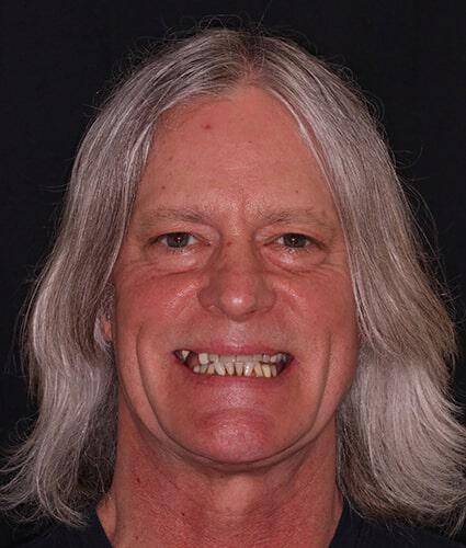 Full Mouth Reconstruction