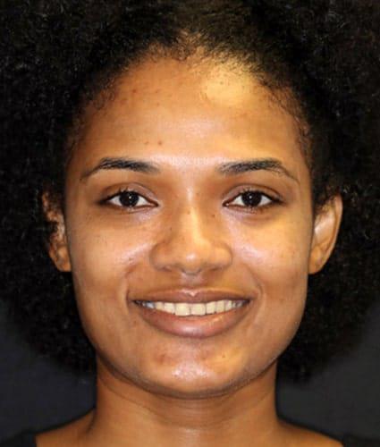 Porcelain Veneers