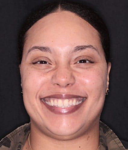 Smile Makeover