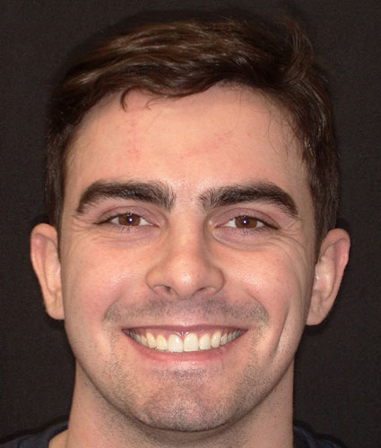 Porcelain Veneers
