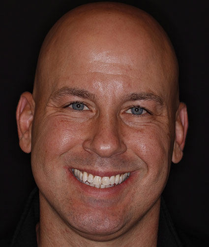 Porcelain Veneers