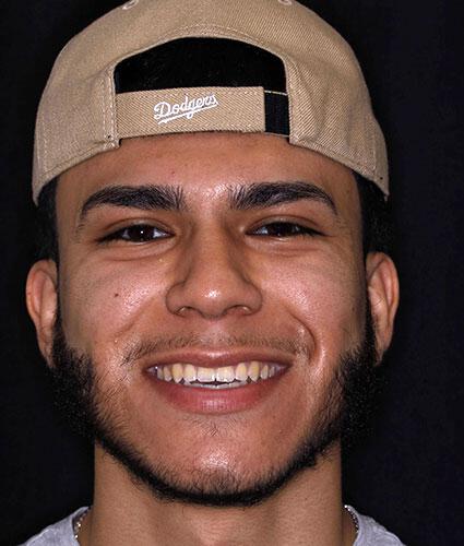 Anthony – Veneers