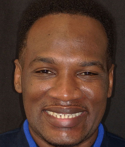 Smile Makeover/ Full Mouth Rehab