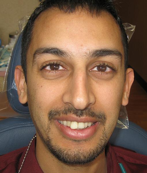 Implant Crowns