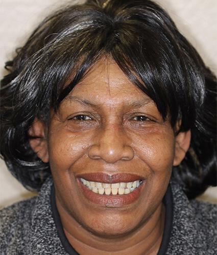 Full Mouth Reconstruction