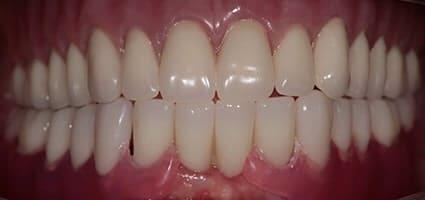 New You Dentures