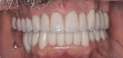 Full Mouth Reconstruction