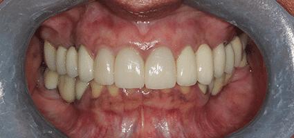 Crowns Full Upper 2