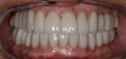 Full Mouth Reconstruction