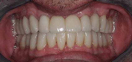 Full Mouth Reconstruction
