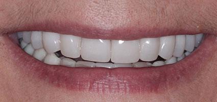 Porcelain Restorations and Neuromuscular Orthotic