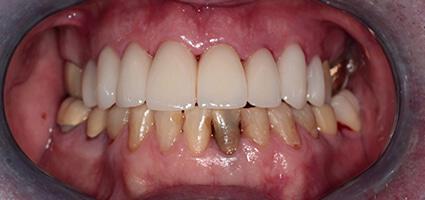 Smile Makeover