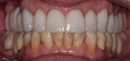 Full Mouth Reconstruction