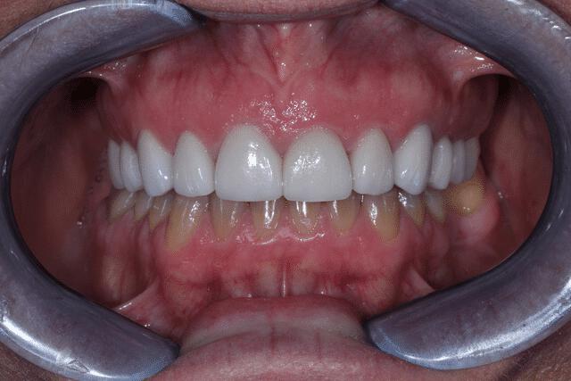 Upper Veneers