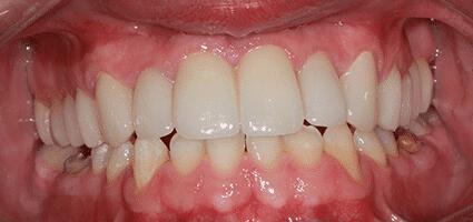 Crowns Full Upper