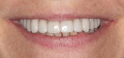 Crowns Full Upper