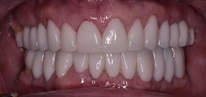 Smile Makeover