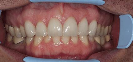 Laminate Veneers