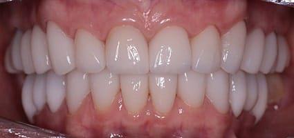 Facial Rejuvenation