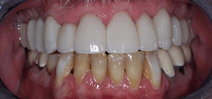 Crowns Full Upper