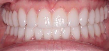 Facial Rejuvenation