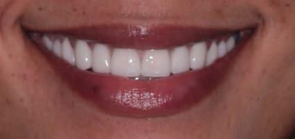 Smile Makeover