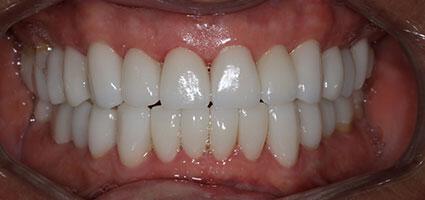 Facial Rejuvenation