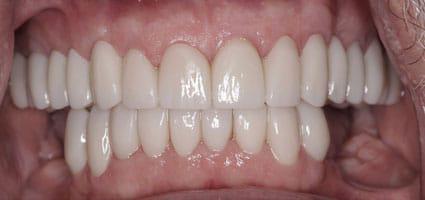 Porcelain Restorations